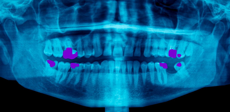 Illustration for article titled El cruel experimento Vipeholm: dos años tomando azúcar para
estudiar la caries